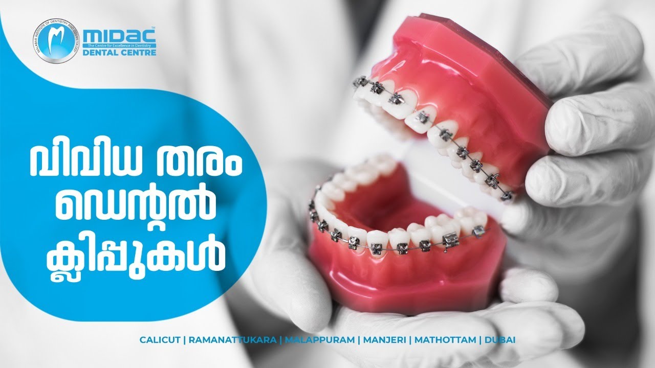 Different types of Dental Clips/ Braces ( Malayalam ) YouTube