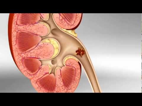How Do Kidney Stones Form? How Can We Prevent Them?
