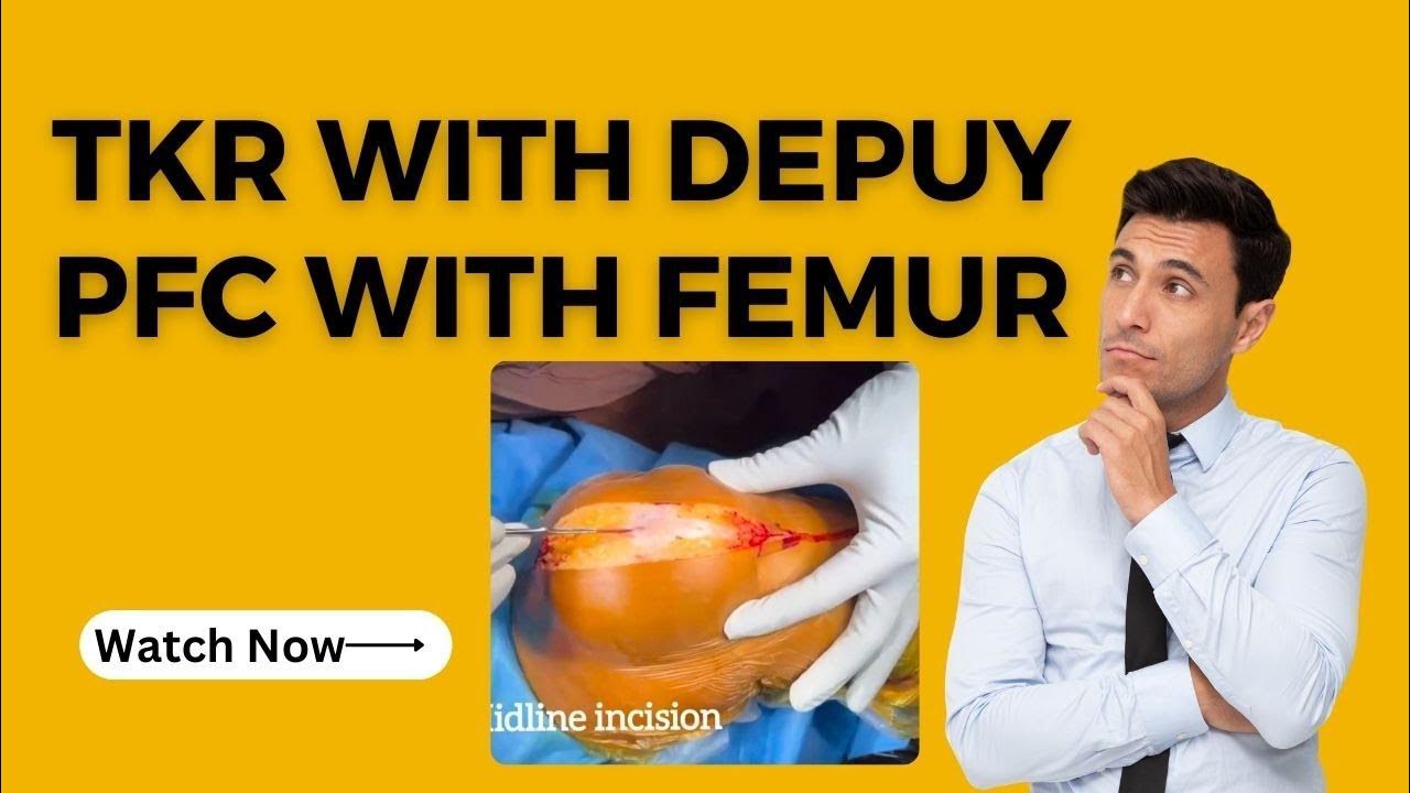 TKR WITH DEPUY PFC WITH FEMUR AND TIBIA EXTENSION RODS AND MOBILISED