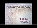 Beware the cd34 halo in dermatofibroma its not dfsp pathology dermpath dermatology