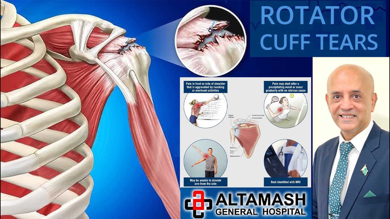 Dr.Yasir Khan.Senior Consultant Orthopedic Surgeon.Rotator Cuff Tear. Altamash General Hospital