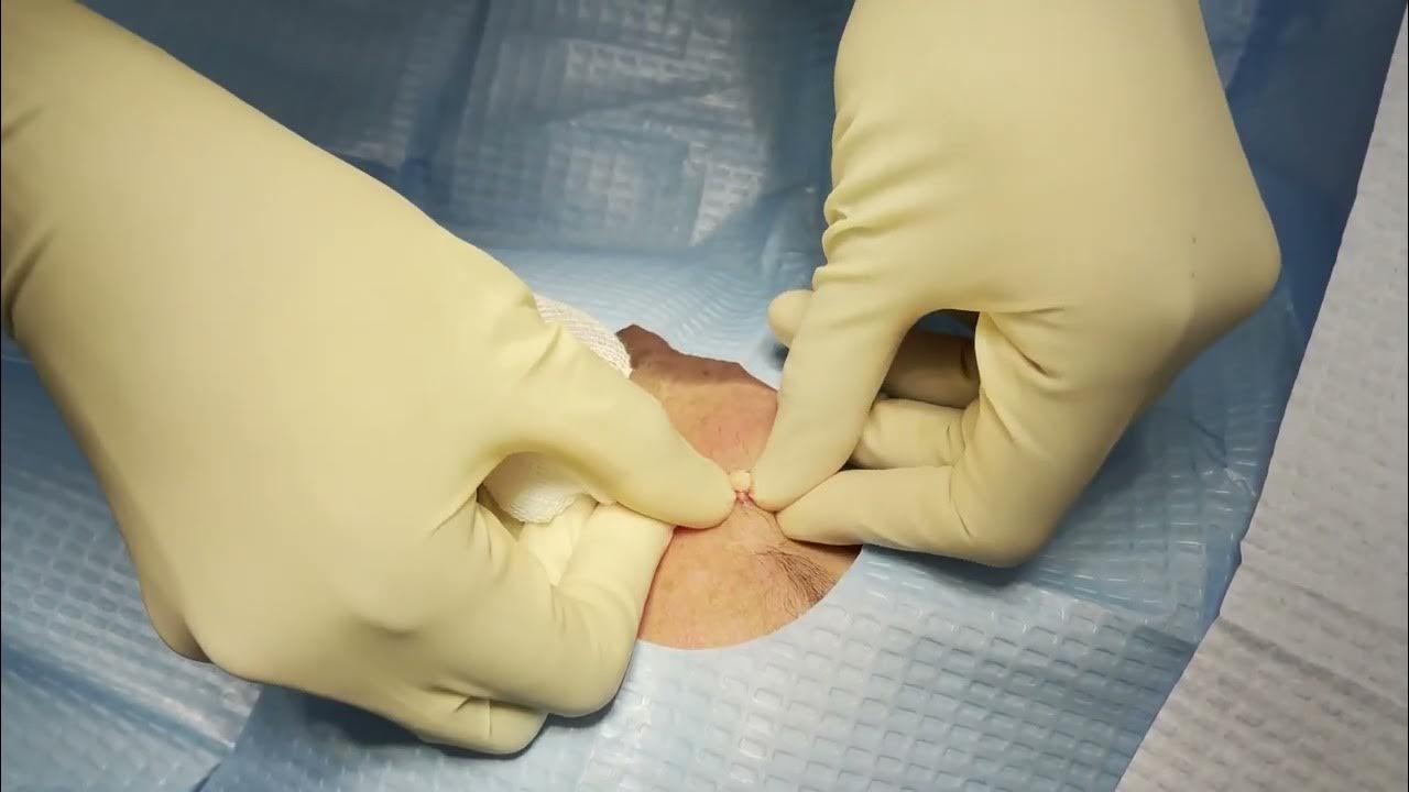 sebaceous-cyst-removal-skin-clinic-robina-youtube