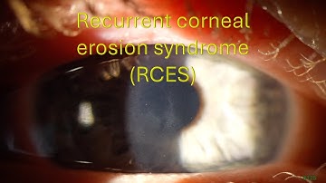 0125: Recurrent corneal erosion syndrome (RCES)