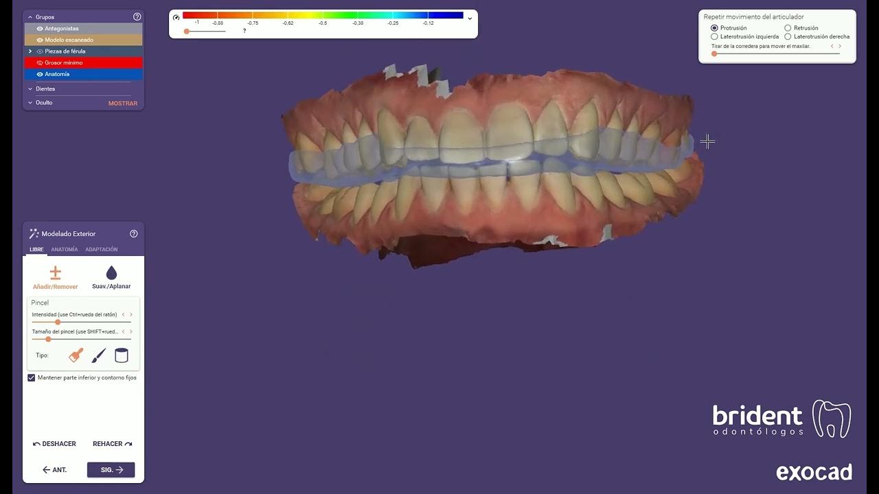 Vídeo 3D Férula de descarga para tratar el bruxismo