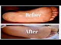 HOW TO GET RID OF DEAD SKIN ON YOUR FEET | HOME DIY