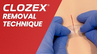 Clozex Removal Technique
