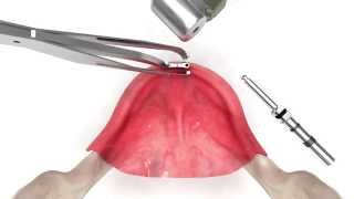 Easy2Fix Surgical Procedure