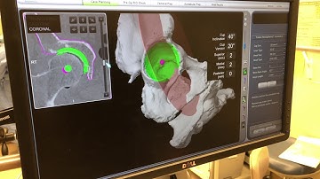 Templating for Robotic Total Hip Replacement