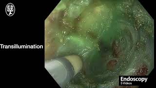 Endoscopic reconstruction of  post-radiation esophageal  obliteration (Endoscopy 2026, DDW 2026)