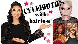 Celebrities with Hair Loss!