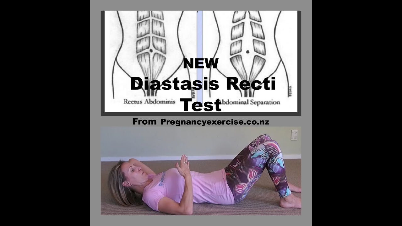 Diastasis Recti New Abdominal Separation Test From Pregnancyexercise