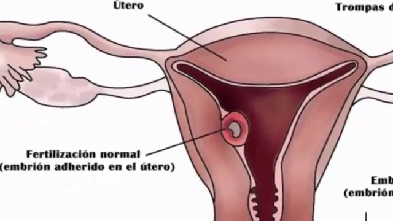 Despues de un embarazo ectopico se puede embarazar