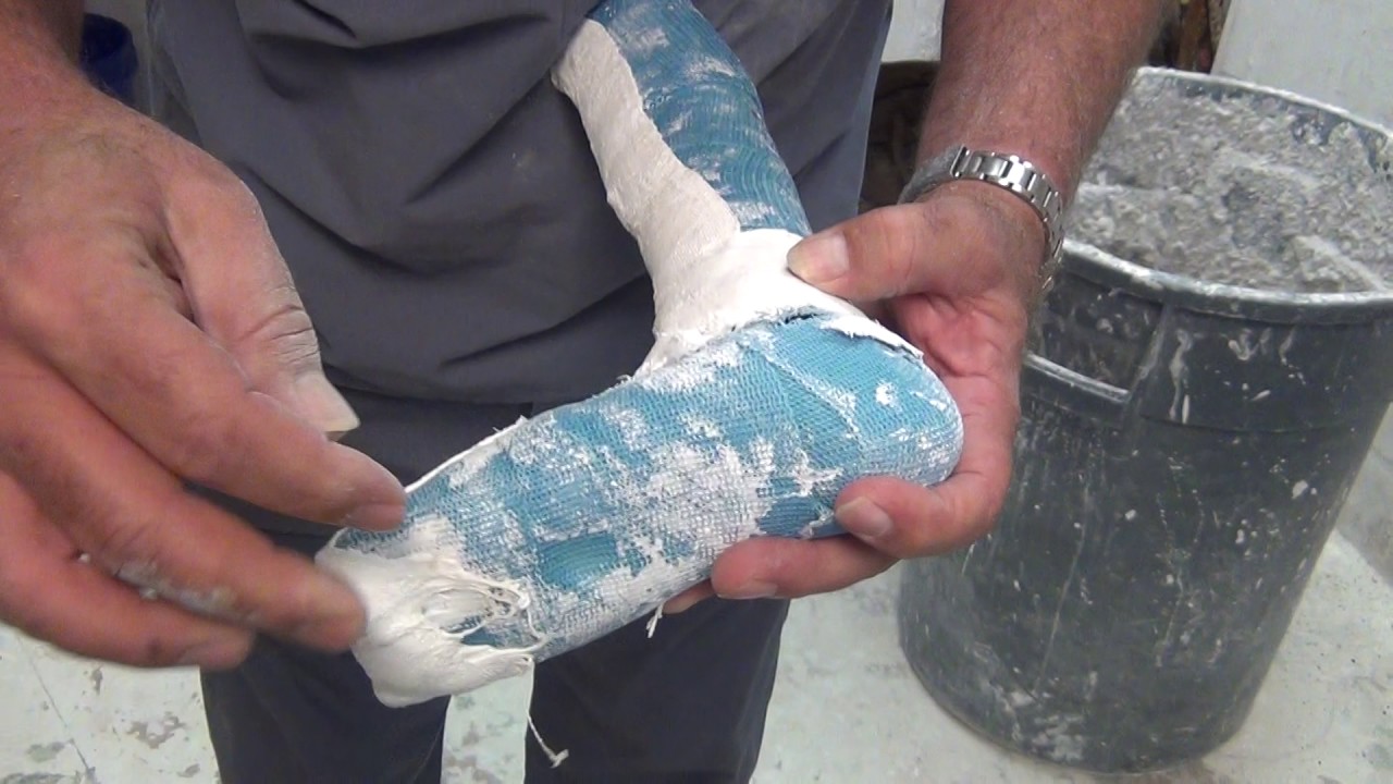 AFO Design Wedging a negative cast to correct valgus/varus, DF/PF