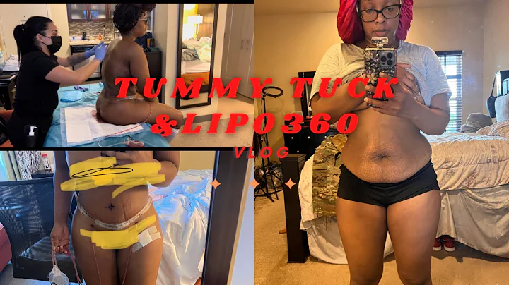 Tummy tuck/Lipo 360 Vlog. NO BBL
