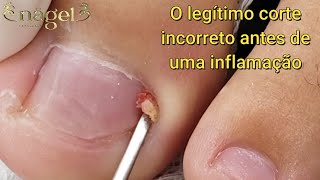 ?NESTE CASO NÃO DÁ PARA FAZER CORRENDO | o início de uma inflamação satisfying viral