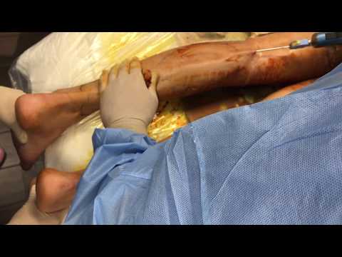 Edgewater, NJ | Liposuction with Fat Grafting to the Calves | The Kaplan Center