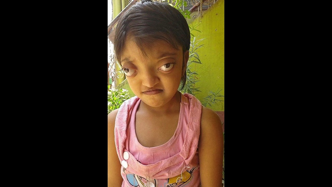 病気で宇宙人のような外見になってしまった少女 Youtube 病気で宇宙人のような外見になってしまった少女 Youtube