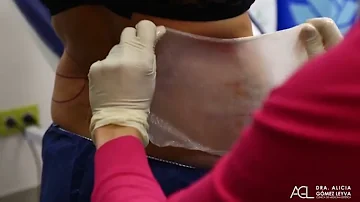 ¿Cómo puedo saber si coolsculpting está funcionando?