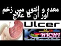 Ulcer السر معدہ اور اس کا علاج