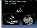 Echocardiographic assessment of bicuspid aortic valve