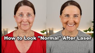 How I Covered My Post-Laser Skin No Heavy Makeup