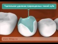 Керамические вкладки