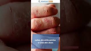 Skin Changes in Dermatomyositis and Vasculitis