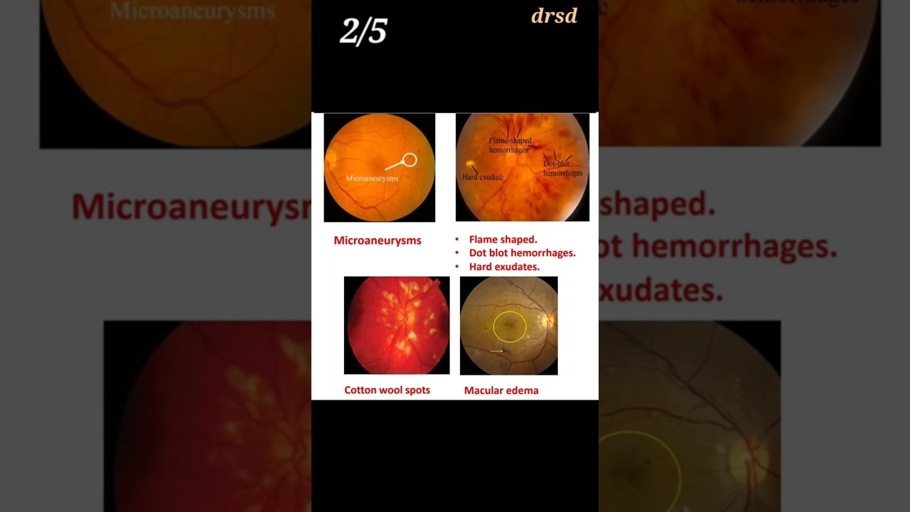 Diabetic Retinopathy #ophthalmology #neetpg #inicet