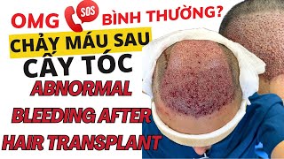 Cha y Ma u Sau Ca y To c Có Bi nh Thu o ng l Abnormal Bleeding After Hair Transplant 