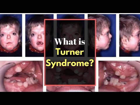 Video: Hur man diagnostiserar Turners syndrom: 11 steg (med bilder)