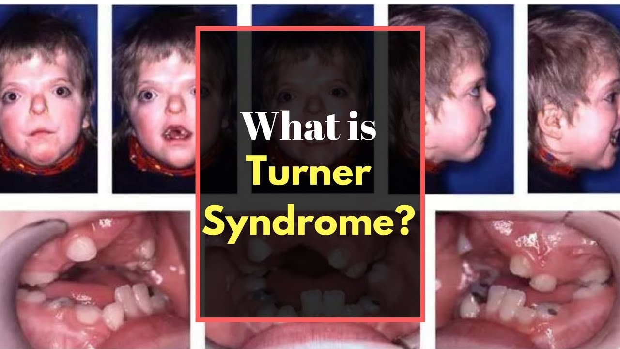 Monosomy Turner Syndrome