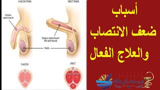 اسباب ضعف الانتصاب وعلاجه الفعال (impotence. Erectile dysfunction (ED