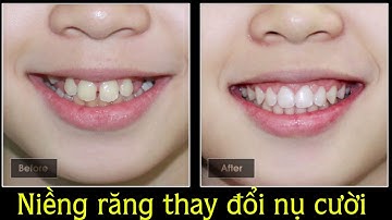 Niềng răng thay đổi nụ cười như thế nào - Braces change smiles  - Nha khoa Việt Ý
