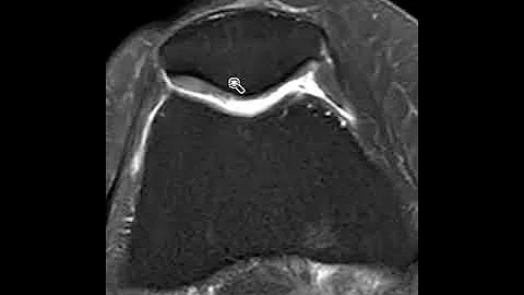 Chondromalacia patella