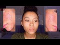 My Acne Journey- Advice for those who are still struggling