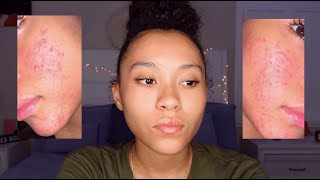 My Acne Journey- Advice for those who are still struggling