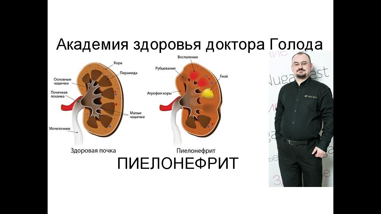 Пиелонефрит – воспаление в почках. - YouTube
