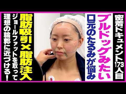[Liposuction for a 25-year-old] Worried about sagging around the mouth and weight under the chin?...