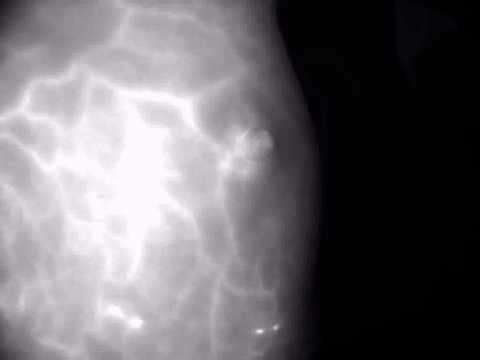 Liu Plastic Surgery - Nipple Sparing Mastectomy Breast Reconstruction - Laser Angiography