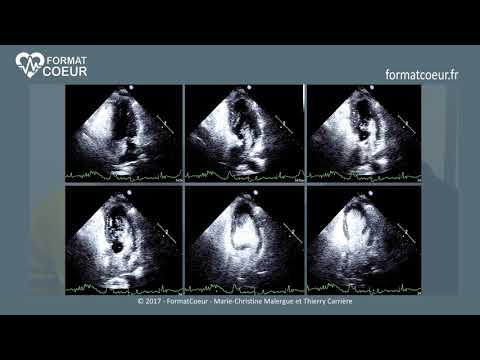 FormatCoeur - Echothèque : Les Echos anormaux des cavités droites