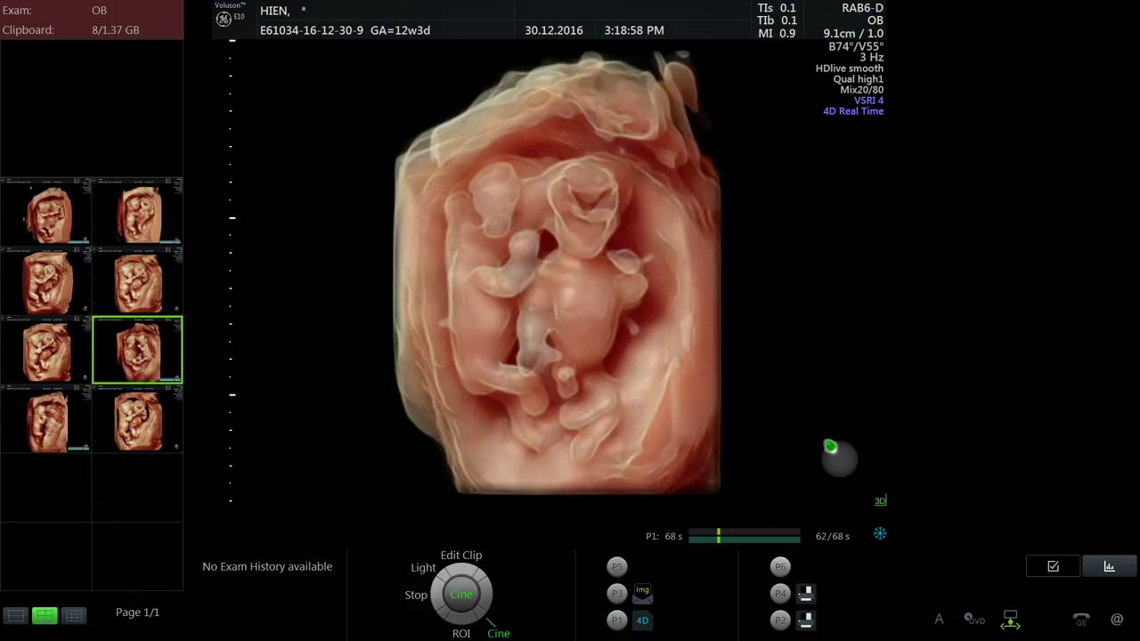 Siêu âm 4D của thai nhi: Bạn đã sẵn sàng để thấy xem thai nhi của mình đang hoạt động như thế nào? Với công nghệ siêu âm 4D, chúng ta có thể thấy được mọi chuyển động của thai nhi trong bụng mẹ một cách rõ ràng và sống động nhất. Hãy sẵn sàng đi vào thế giới đầy kỳ diệu và phát hiện những bức ảnh tuyệt đẹp này về thai nhi.