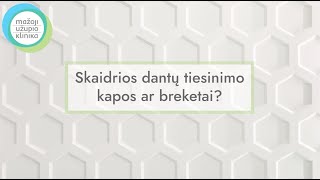Dantų tiesinimo kapos ar breketai?