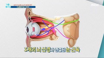 [기분 좋은 날] 갑자기 눈에 사시가 생겼다면? ＜뇌종양＞일 수 있다! MBC 200921 방송