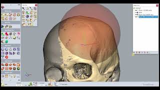 3D Printed Medical Implant Designing with Geomagic Freeform & Haptic Device | Graft3D Healthcare screenshot 3