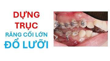 Dựng trục răng cối đổ lưỡi, case Góc thấp/Góc cao - Dr.Thai Ortho