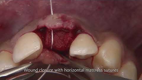 Soft-tissue augmentation around dental implants. Case 2