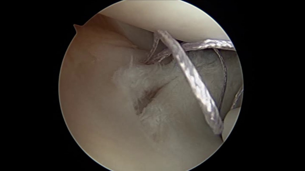 Meniscus Repair: All-Inside technique - YouTube