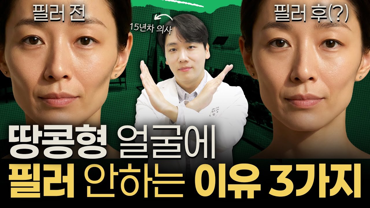 '얼굴형 예뻐지는 방법' 전부 알려드릴게요!!! 땅콩형 얼굴에 제발 필러 맞지 마세요ㅠㅠ