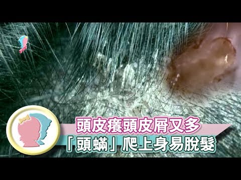 《頭皮癢頭皮屑又多    小心是「頭蟎」爬上身容易脫髮》【育兒幫寶典】《疾病對抗》│寶貝幫TV