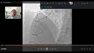 Açtığımız Damarlara Artık Stent Takmadan İlaçlı Balonlar İle Tedavi Ediyoruz